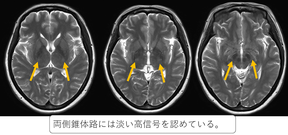 錐体外路系の解剖学